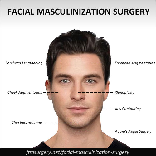 Facial Masculinization Surgery (FMS) - FTM Facial Surgery